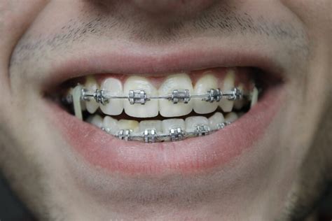 Understanding What is Metal Braces Materials